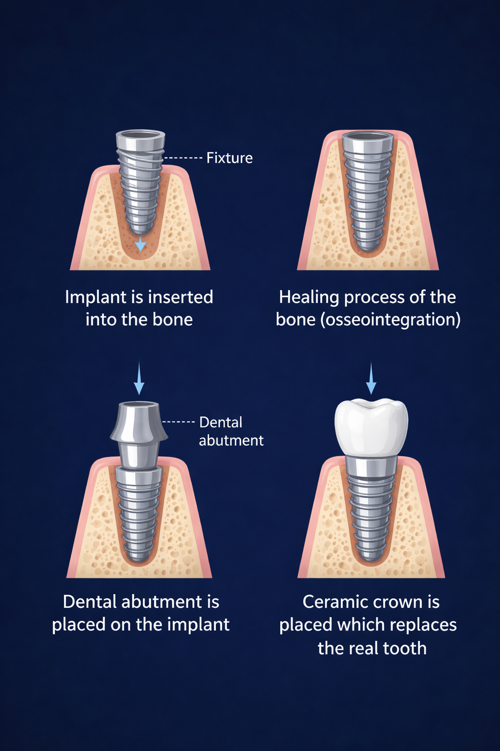 Dental implant surgery at Supreme Elite Clinic